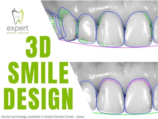 3D Smile Design